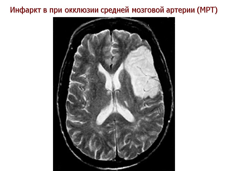 Инфаркт в при окклюзии средней мозговой артерии (МРТ)